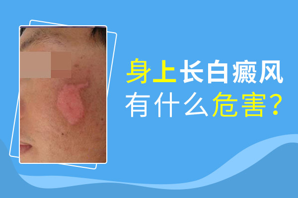 白癜風(fēng)危害,白癜風(fēng)的影響