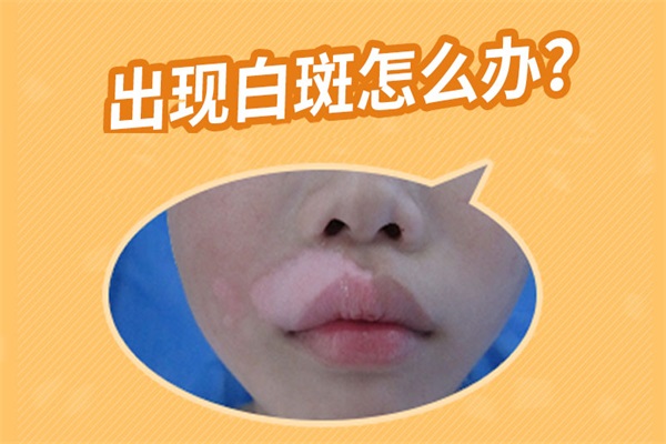 老年白癜風怎么治療比較好